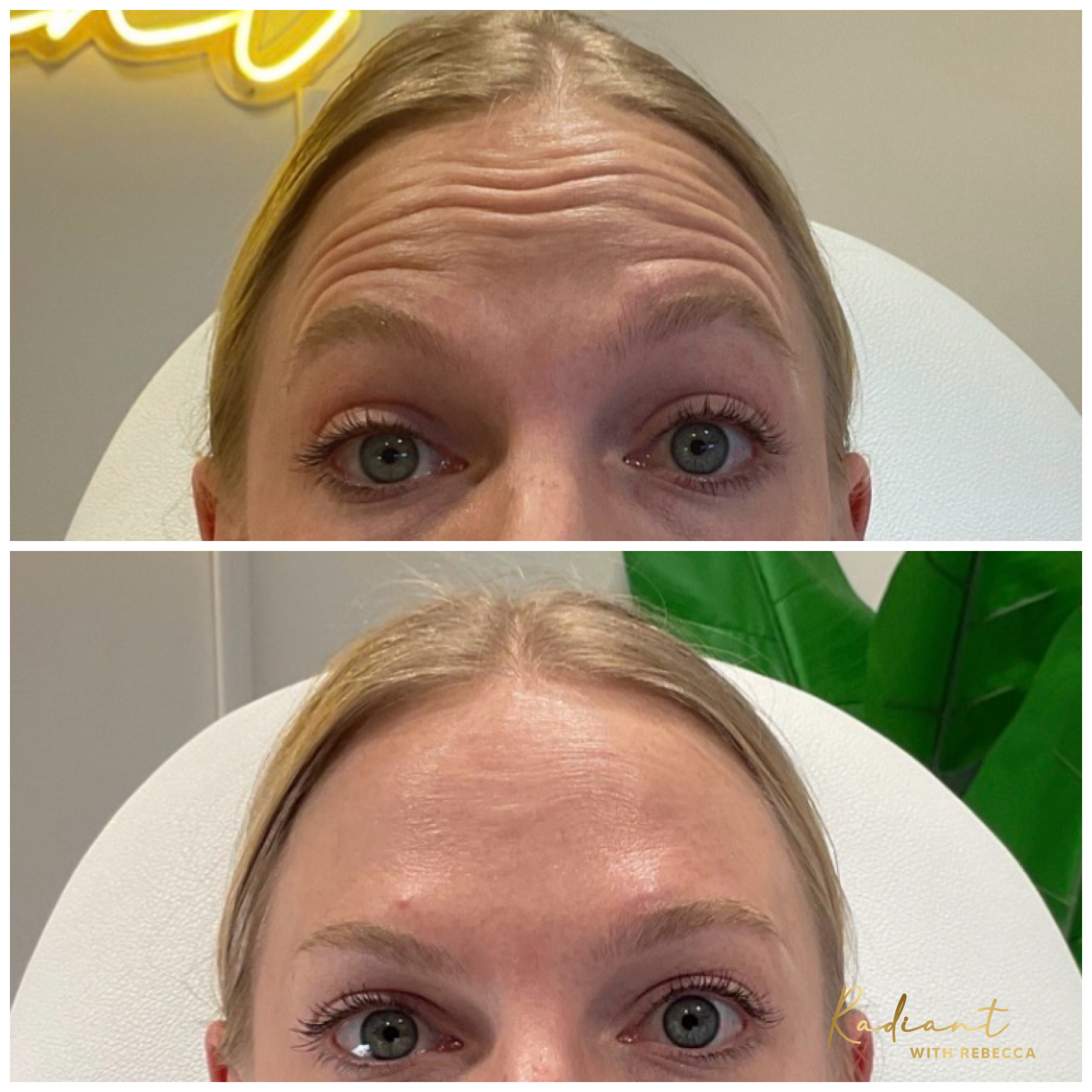 Botox® before and after showing smoothed forehead wrinkles