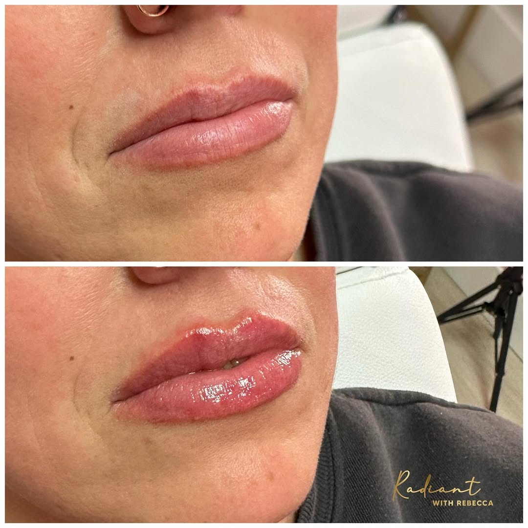 Close-up of naturally enhanced lips after dermal filler at Radiant Med Spa