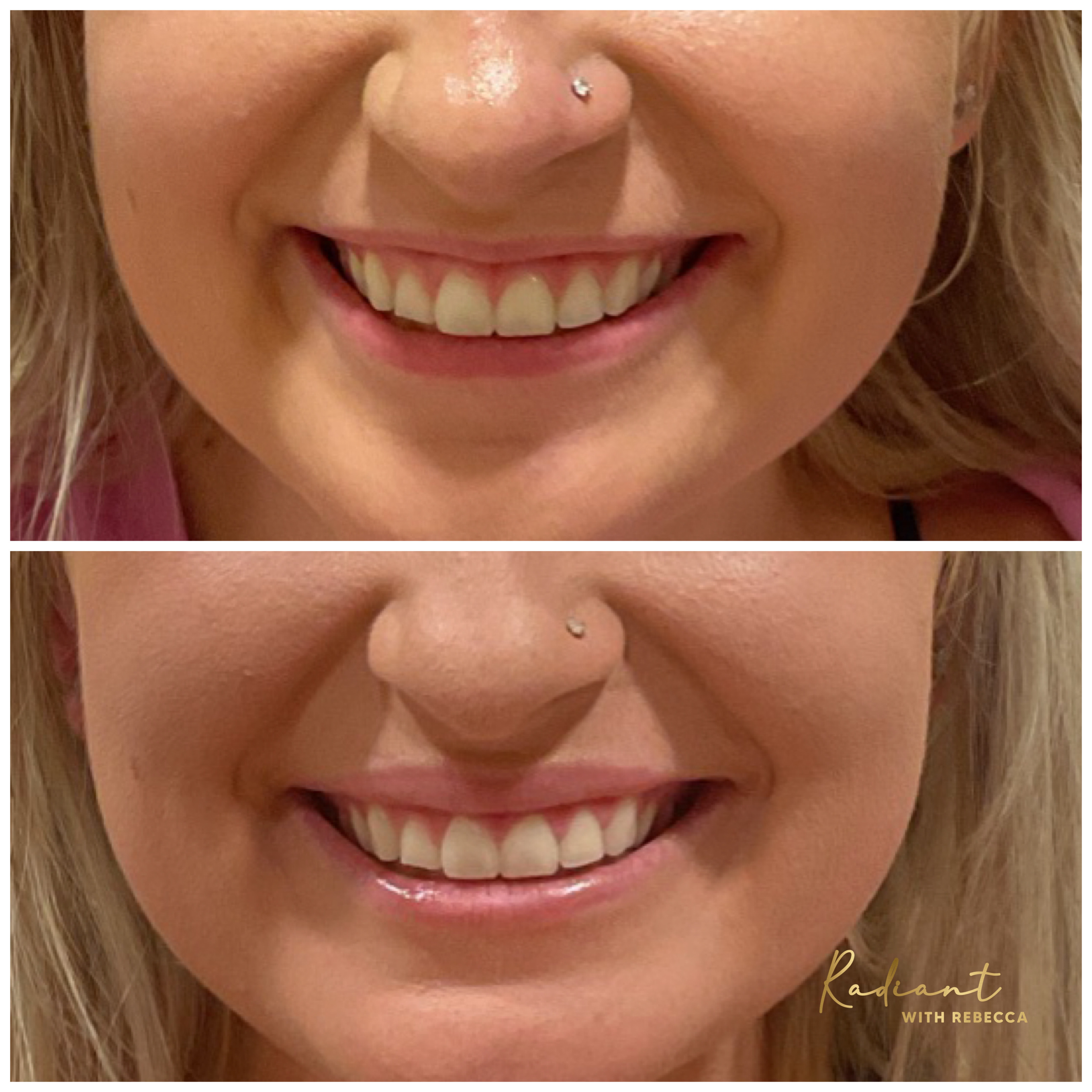 Lip Flip result