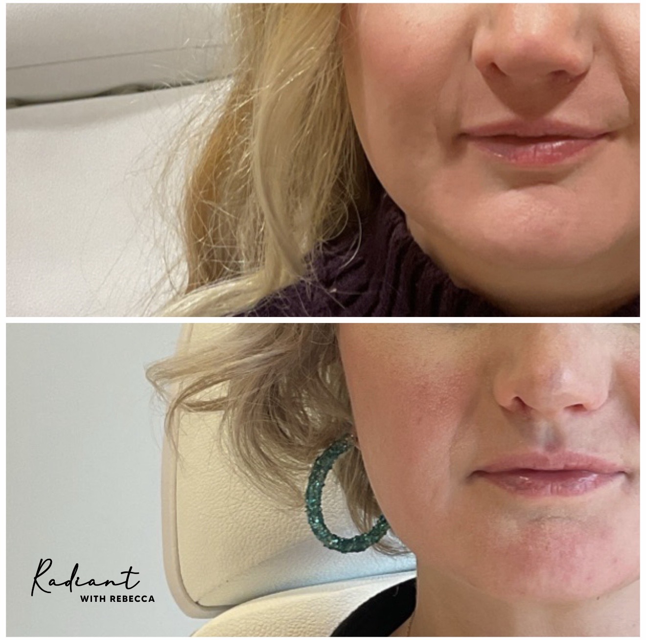 Masseter Botox result