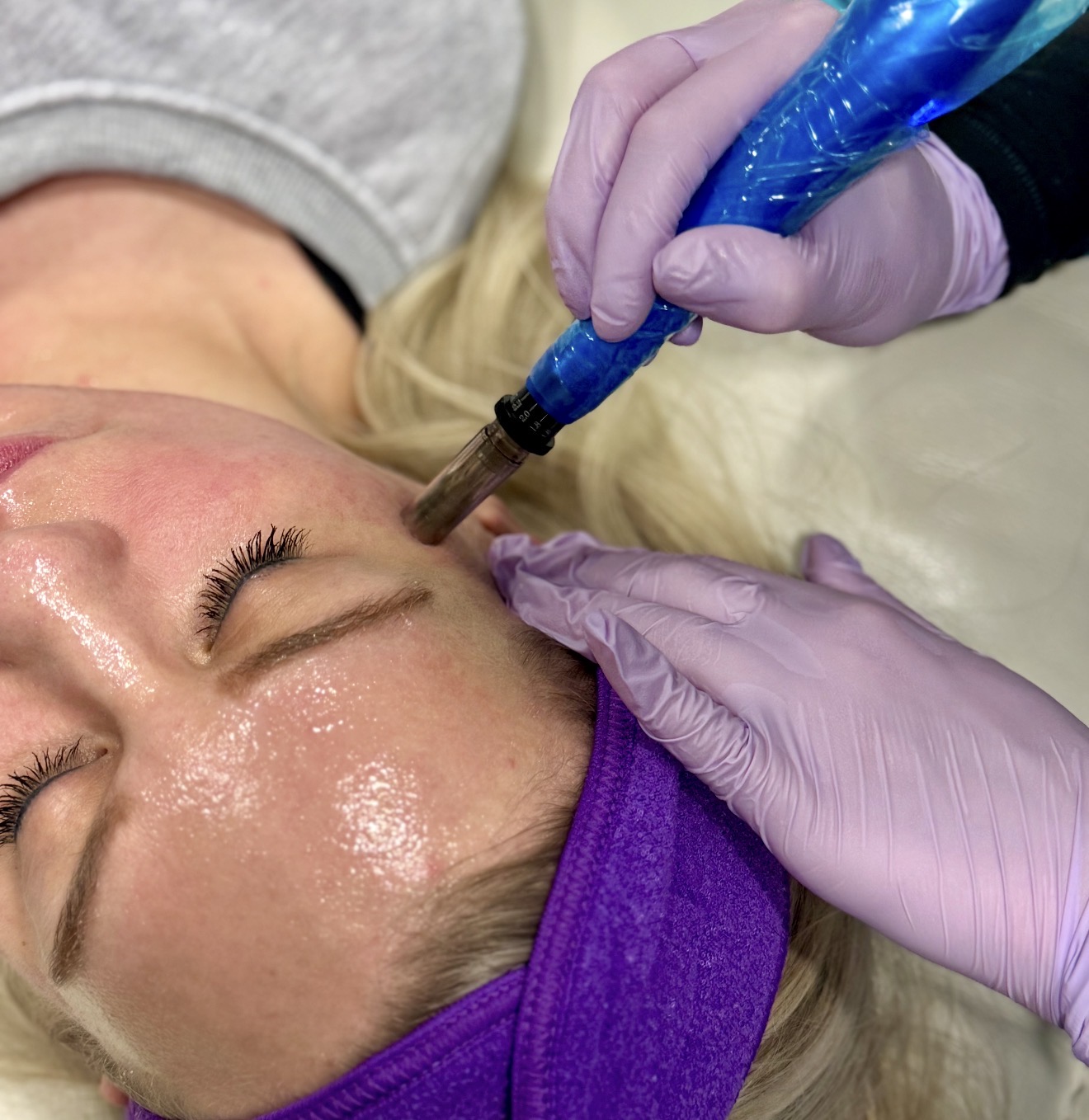 PDRN microneedling treatment being performed on a client at Radiant Med Spa